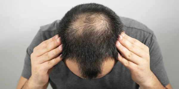 Male patient showing crown thinning from androgenetic alopecia