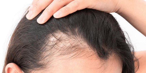 Thinning hair due to Androgenetic Alopecia