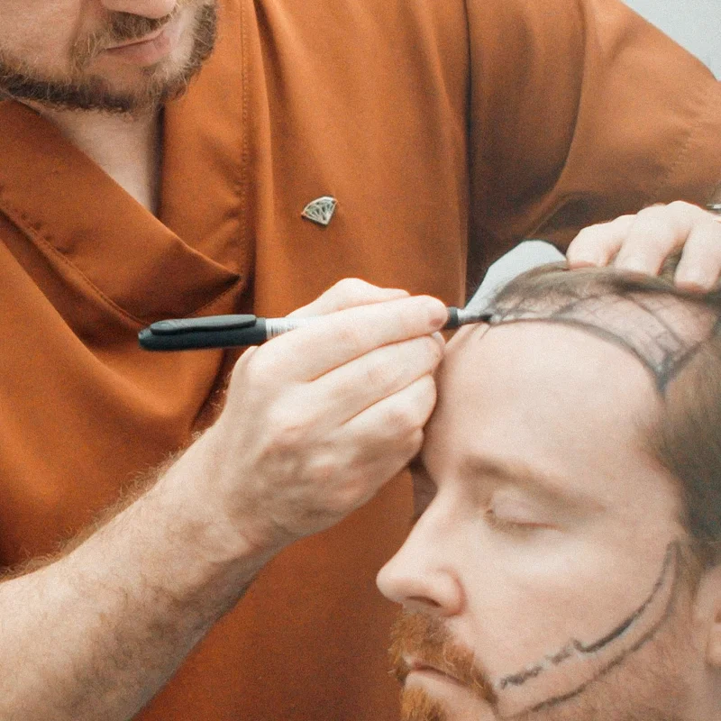 Hair transplant consultation and hairline design at Sanabria Clinic