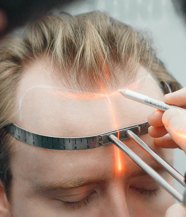 Measuring hairline design during consultation at Sanabria Clinic