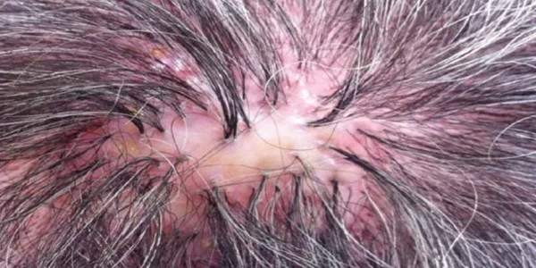 Scalp redness and patchy hair loss caused by folliculitis decalvans