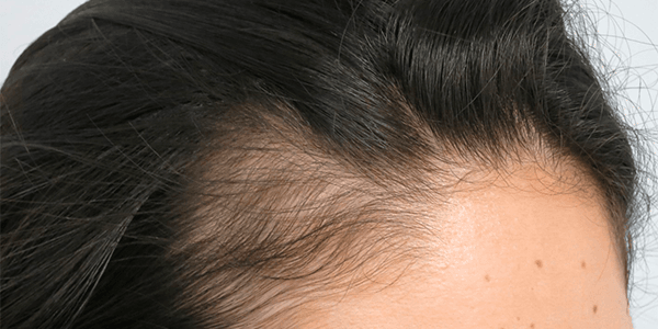 Shedding hair due to Telogen Effluvium