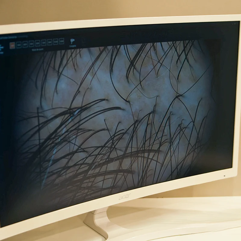 Microscopic scalp analysis using trichoscopy at Sanabria Clinic