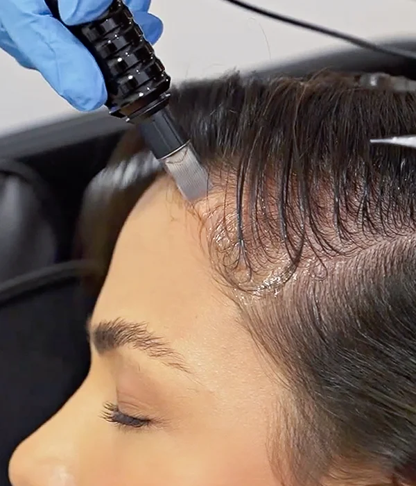 Hair restoration treatment on female hairline
