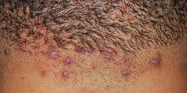 Inflammation and scarring from acne keloidalis nuchae on scalp