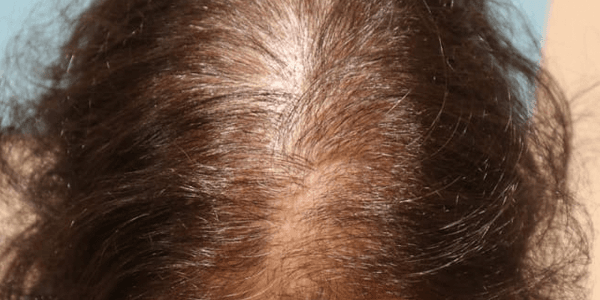 Hair part showing hair loss due to hormonal changes