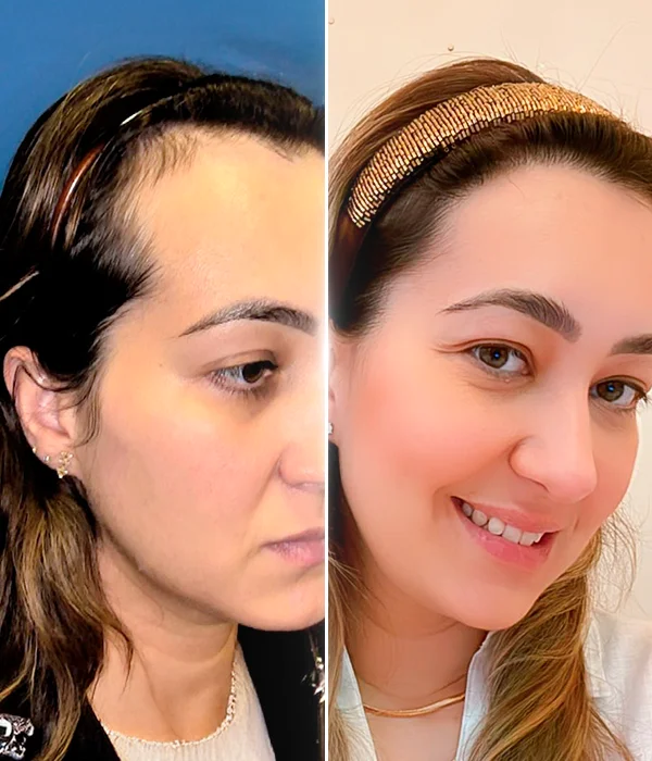 Before-and-after female hair transplant restoring density