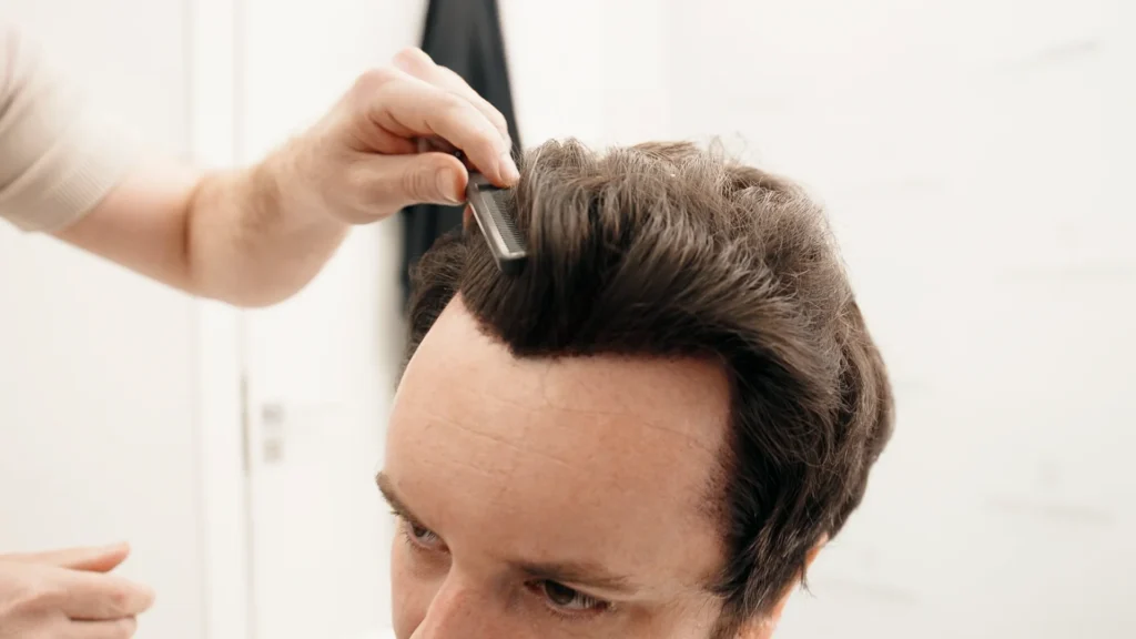 Hair Transplant Results: 5,000 Grafts Explained