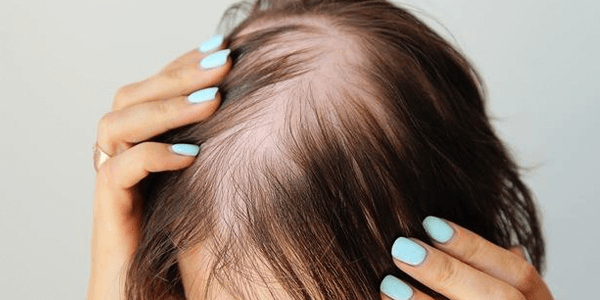 Thinning hair due to Thyroid Imbalance Hair growth impaired by nutritional