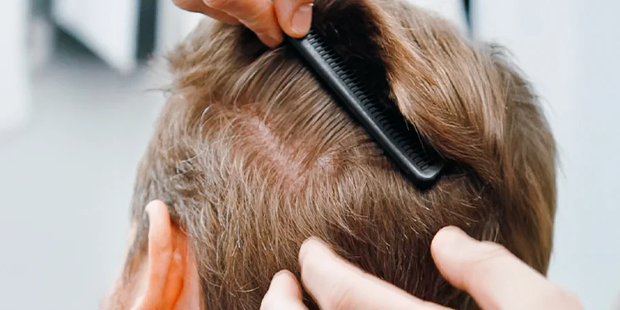 Combing donor area after no-shave FUE hair transplant with no visible signs of surgery