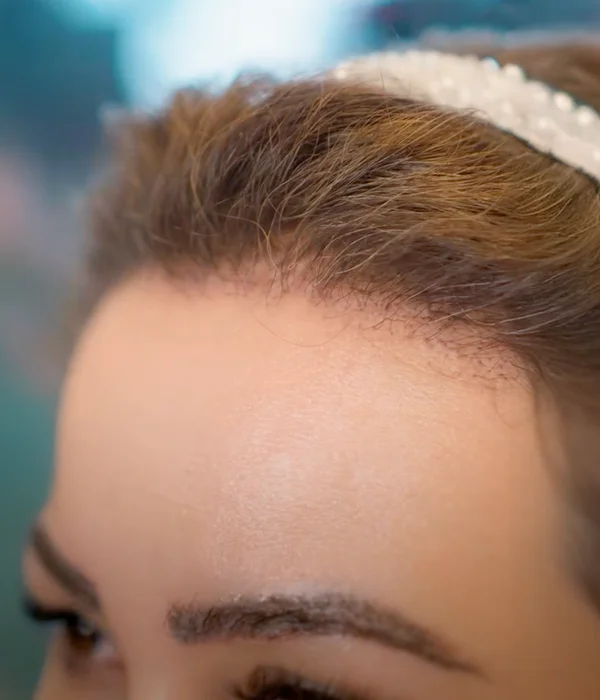 Close-up of natural hairline after female hair restoration