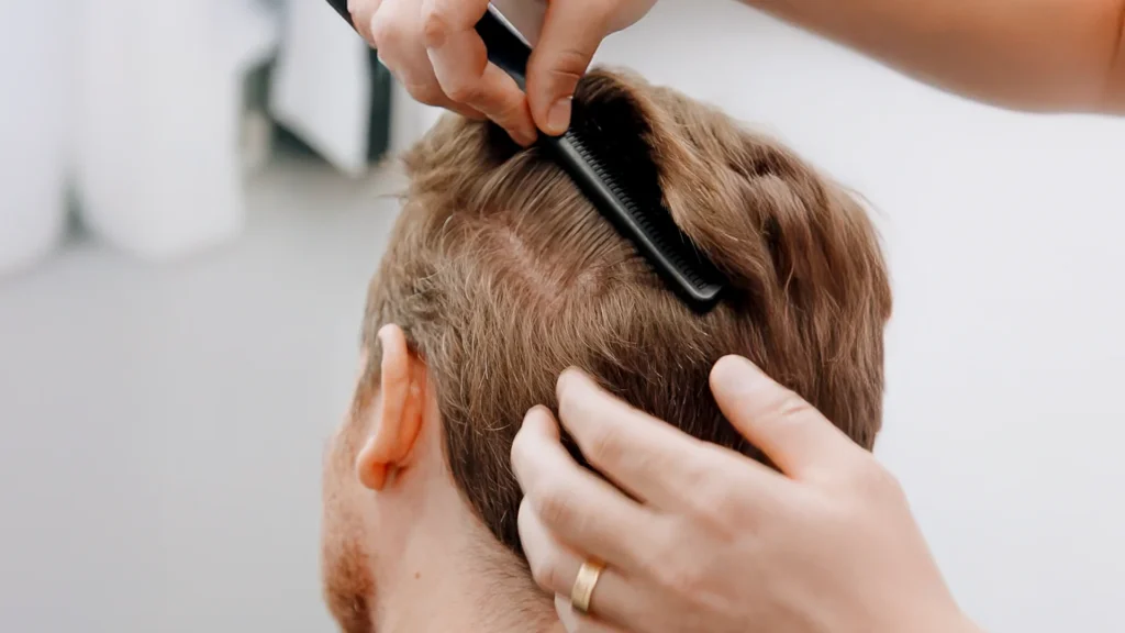 FUE or FUT – Which Hair Transplant Is Best for You?