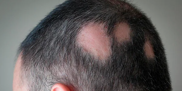 Patchy scalp hair loss caused by alopecia areata