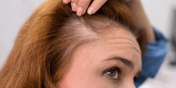 Scalp irritation due to Seborrheic Dermatitis