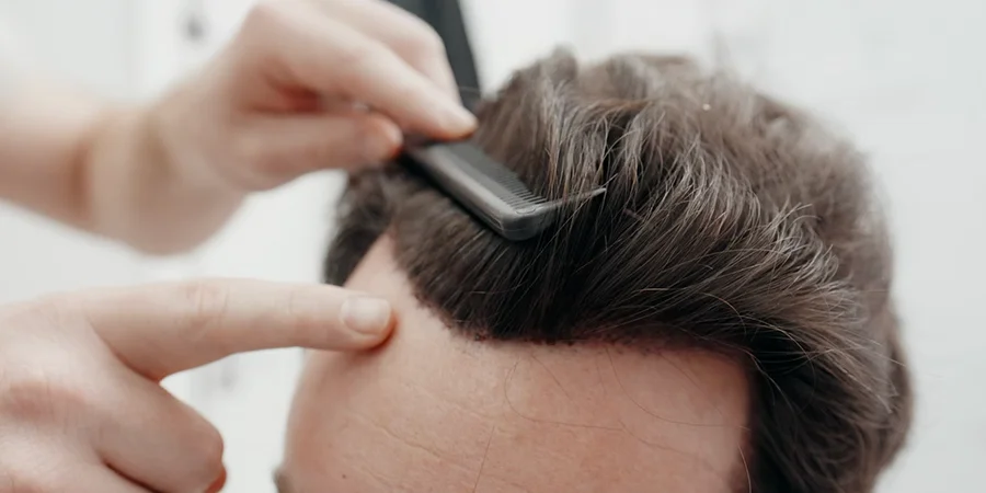 Thousands of hair follicles transplanted in a single treatment