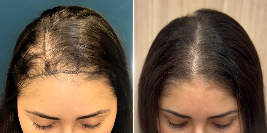 Before-and-after female hair restoration preserving natural hairstyle