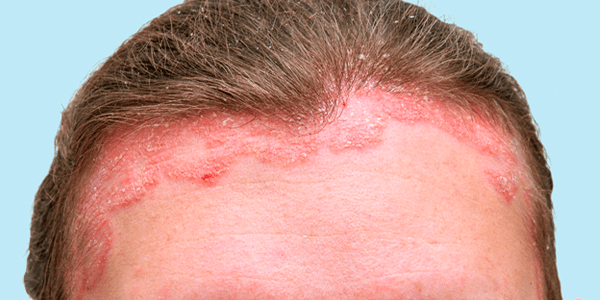 Scalp inflammation and scaling due to Psoriasis