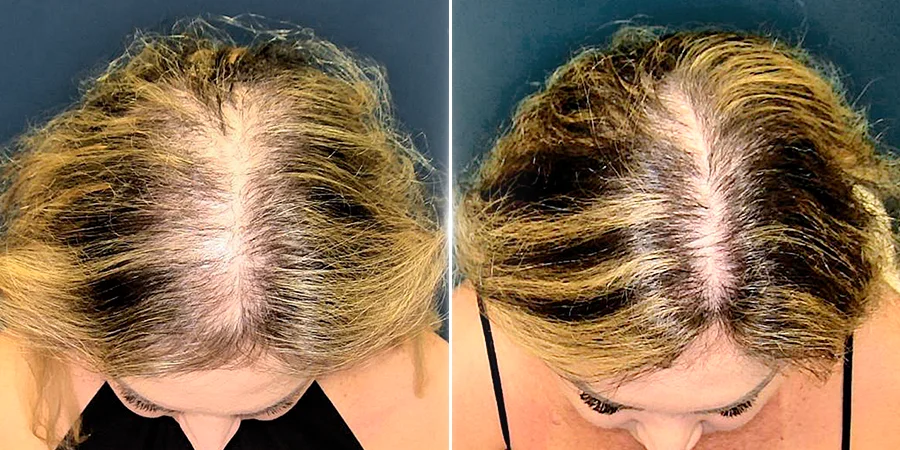 Before-and-after female hair transplant showing discreet donor area