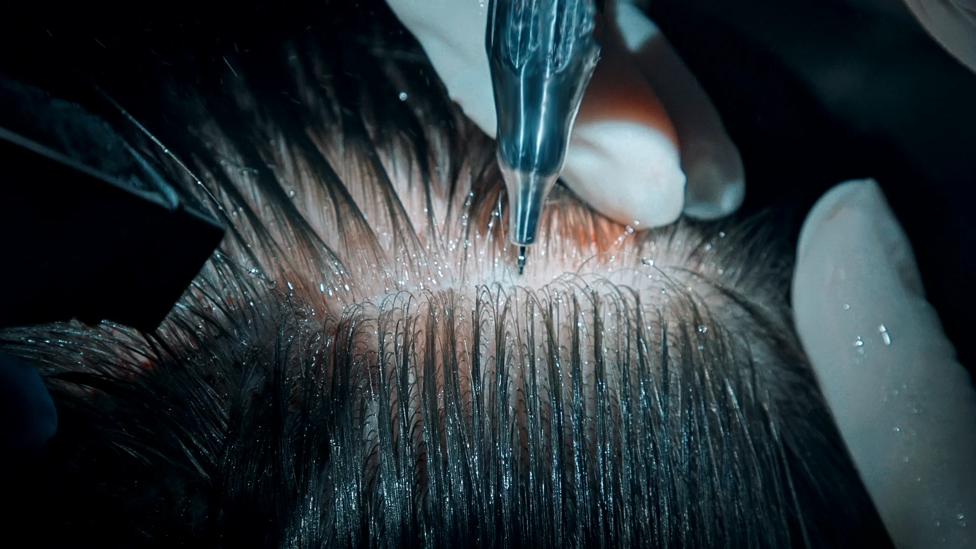 Close-up trichoscopy image showing hair follicles on scalp