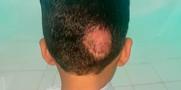 Round bald patch on scalp caused by tinea capitis