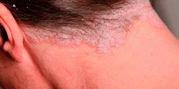 Patchy hair loss due to Alopecia Areata