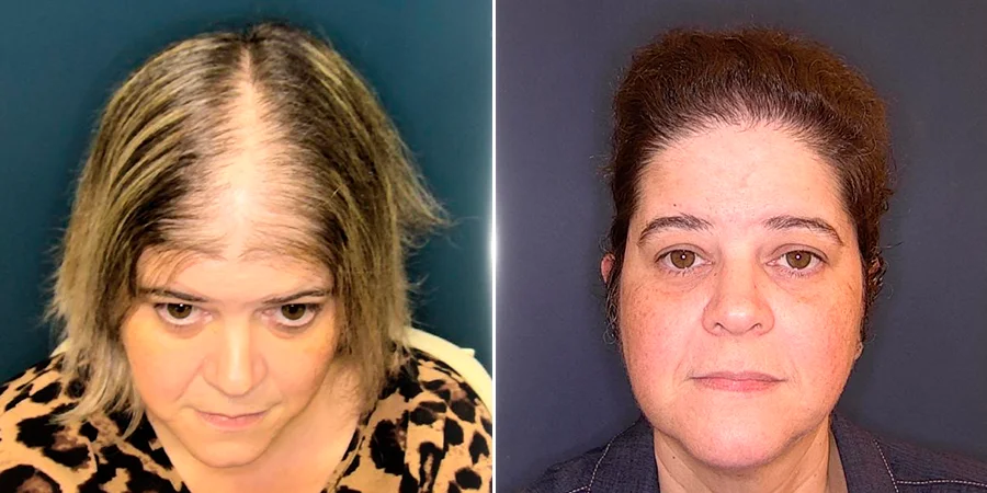 Before-and-after female hair restoration with high-density growth