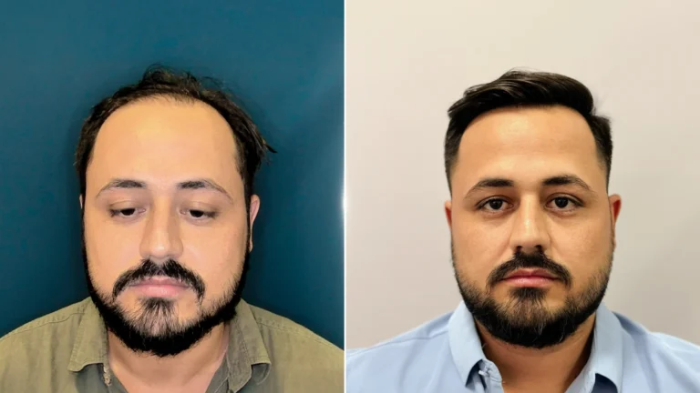 No-shave FUE hair transplant before-and-after results