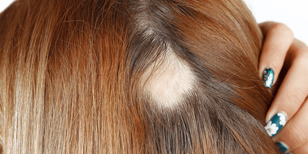 Scarring due to Frontal Fibrosing Alopecia (FFA)