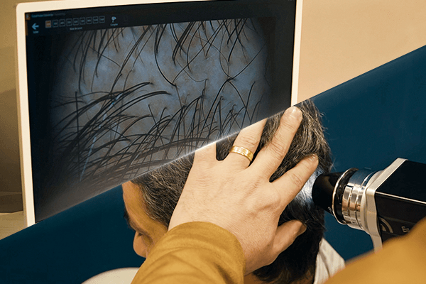 Trichoscopy scalp analysis using FotoFinder technology at Sanabria Clinic