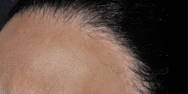 Scalp inflammation due to Lichen Planopilaris