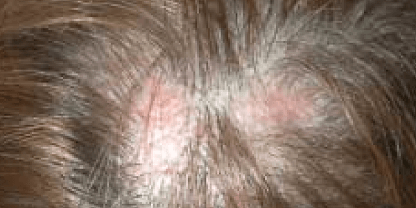 Painful, scaly plaques on scalp due to