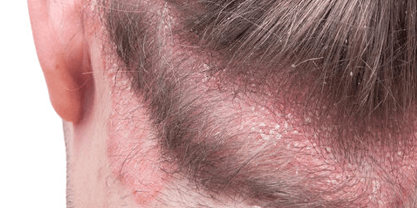 Scalp fungal infection due to Tinea Capitis
