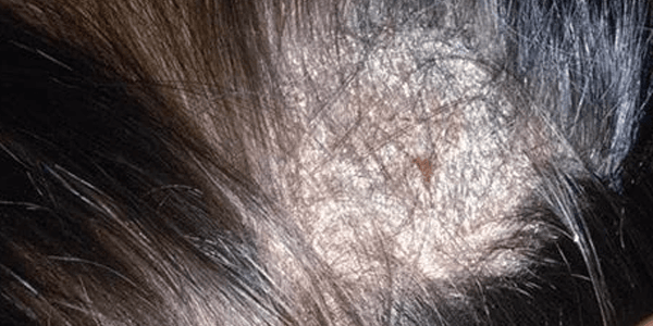 Microscopic scalp analysis using trichoscopy for female patient
