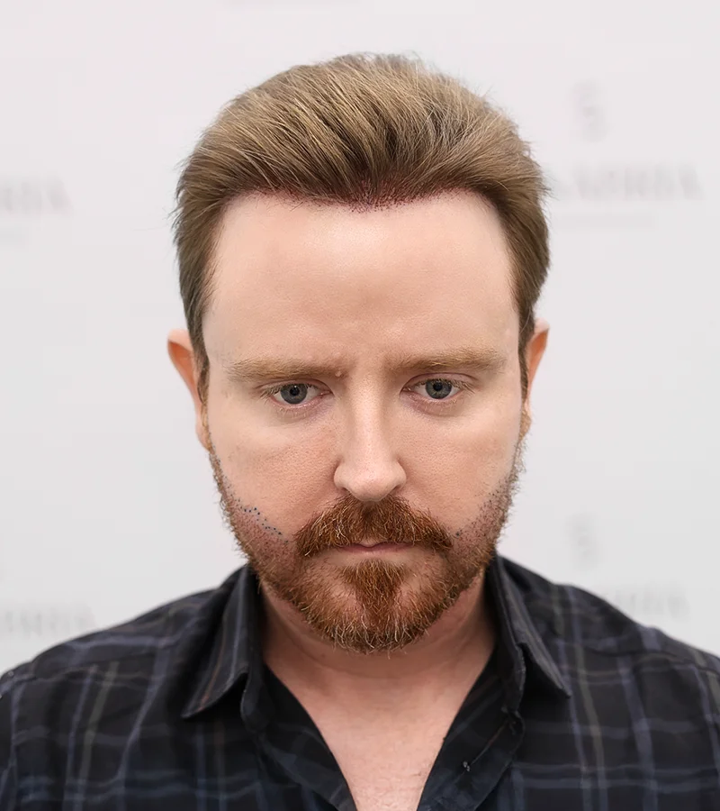 about-after Before-and-after high-density hair transplant results at Sanabria Clinic