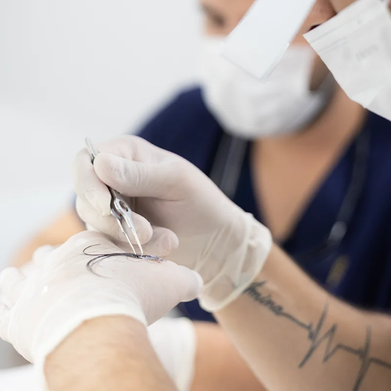 Close-up of precision hair transplant procedure at Sanabria Aesthetics
