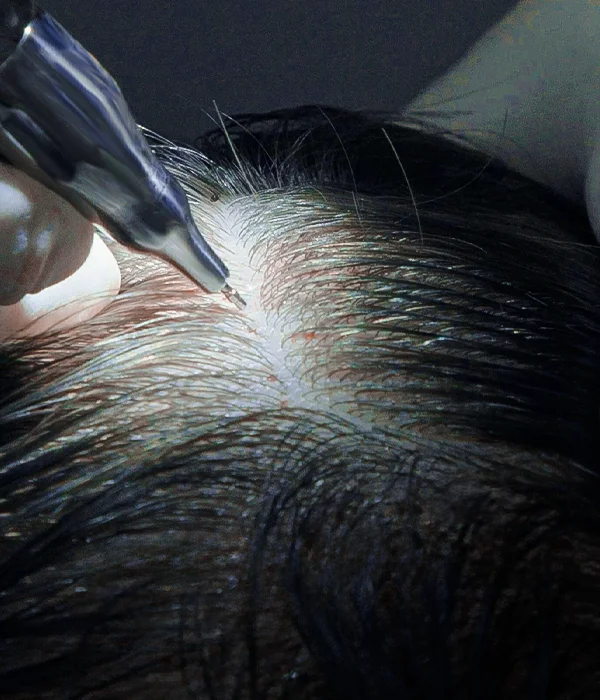 Minimally invasive High-Count No-Shave FUE hair transplant procedure close-up
