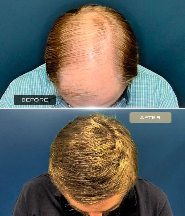 ultra high-count FUE crown restoration before and after