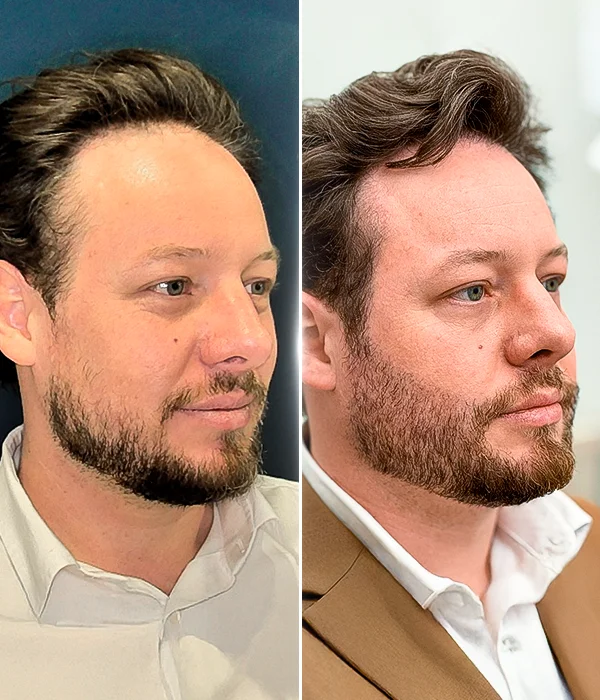 Male hair restoration before-and-after results at Sanabria Aesthetics