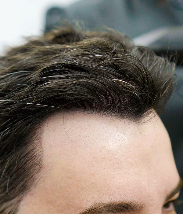 Male patient maintaining natural hair length after High-Count No-Shave FUE transplant