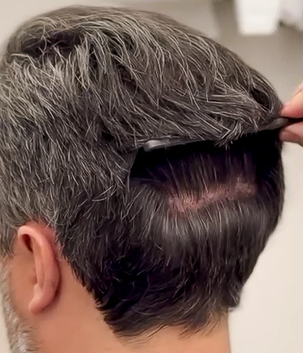 ultra high-count FUE showing natural hair appearance post-transplant