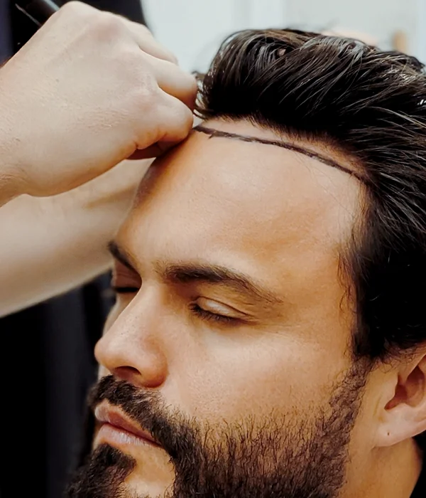 Hair restoration planning for male patient with receding hairline at Sanabria Clinic
