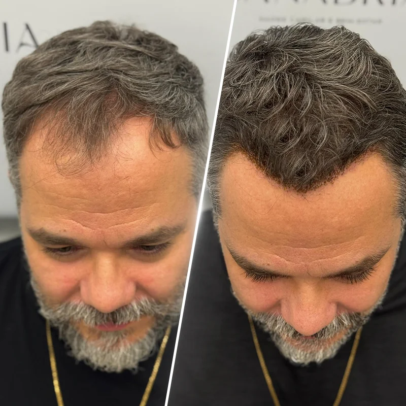 High-Count No-Shave FUE before-and-after hairline restoration
