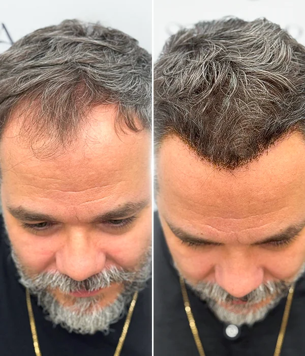 Before-and-after hair restoration results for male patient with crown thinning at Sanabria Clinic
