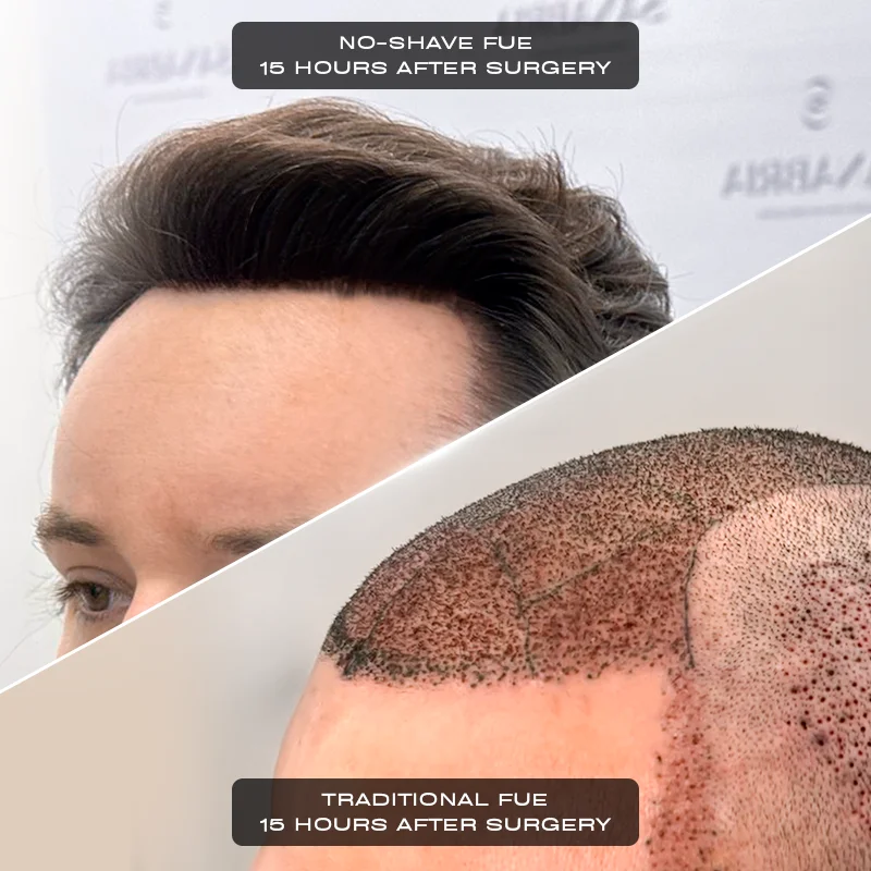 High-Count No-Shave FUE donor area preparation with design markings