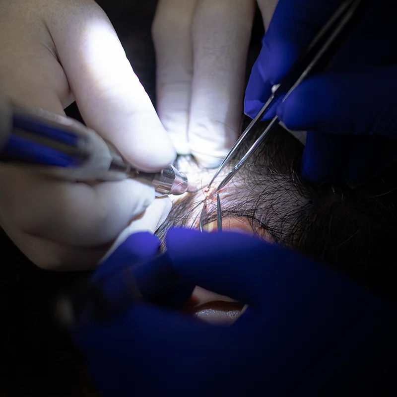 ultra high-count FUE hair transplant procedure close-up