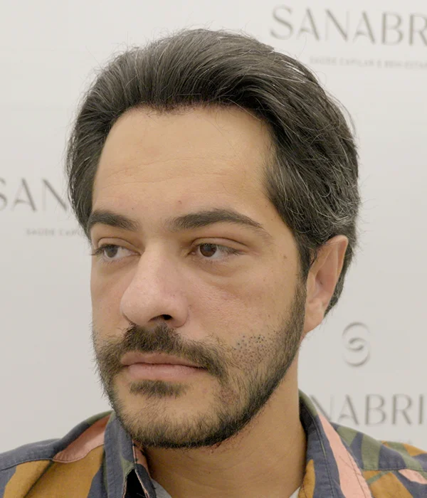 Natural results for restoring male hairline at Sanabria Clinic