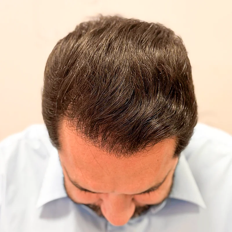 after – Outros_Ultra High-Count FUE_Sanabria Aesthetics High-Count No-Shave FUE after results showing hairline