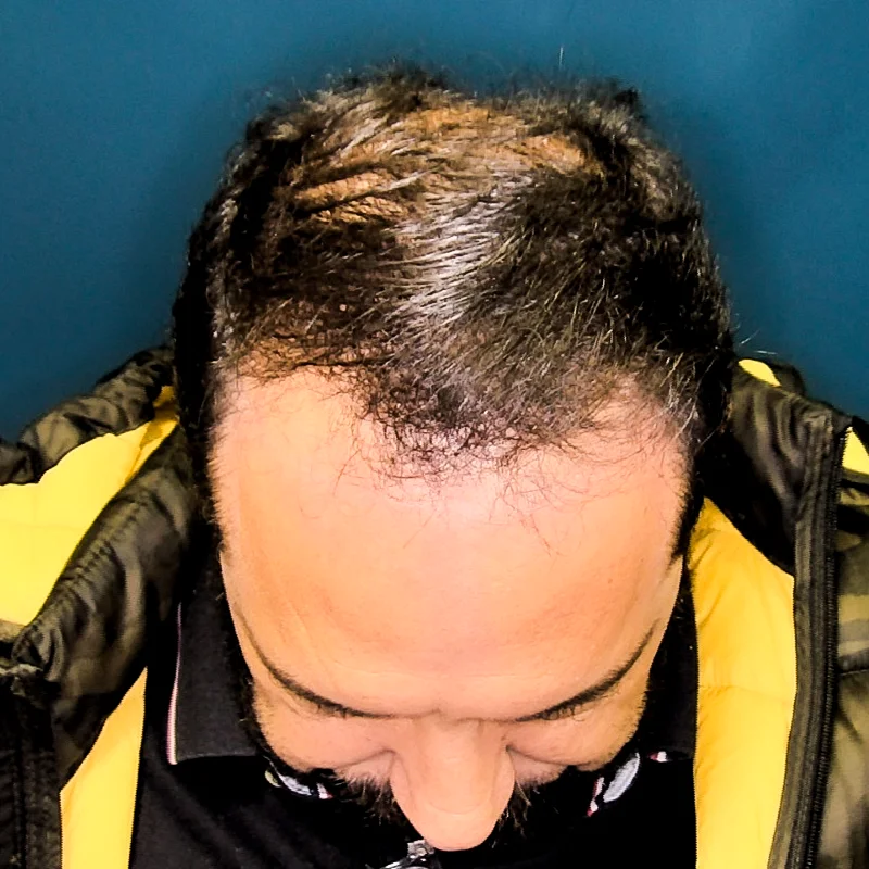 before – Ultra High-Count FUE_Sanabria Aesthetics High-Count No-Shave FUE before results showing restored hairline